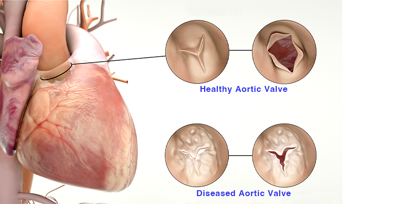 Diseased vs. Healthy Heart Valve
